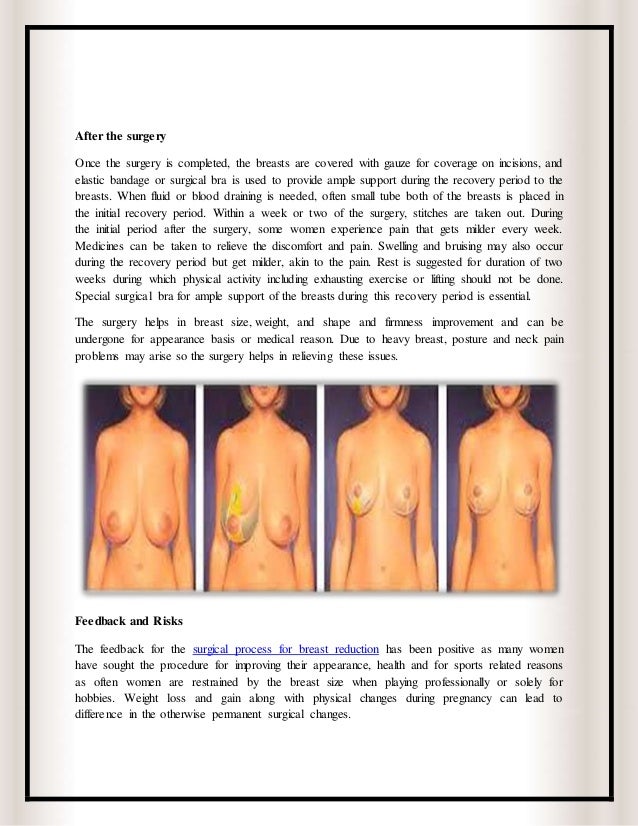 breast reduction after gastrc bypass surgery Hot tub sex vidieo